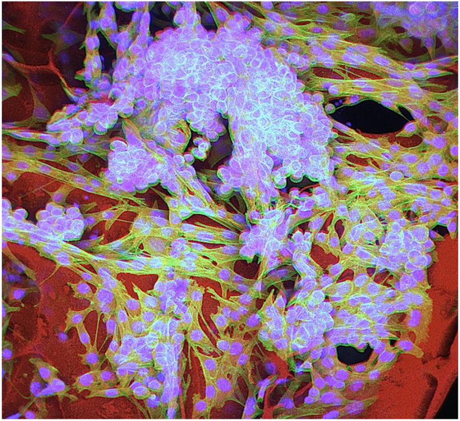 Confocal image of an injectable tumor cell infused anti-cancer cryogel vaccine_Sidi Bencherif