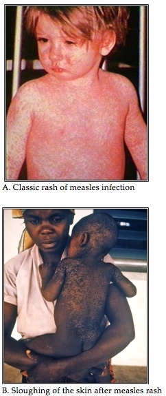 Clinical Presentations of Measles