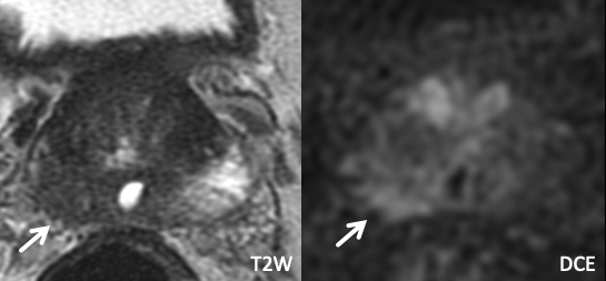 Irregularity along the right posterolateral prostate border
