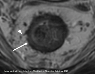 After Neoadjuvant Treatment MRI – T2WI, Spiculated