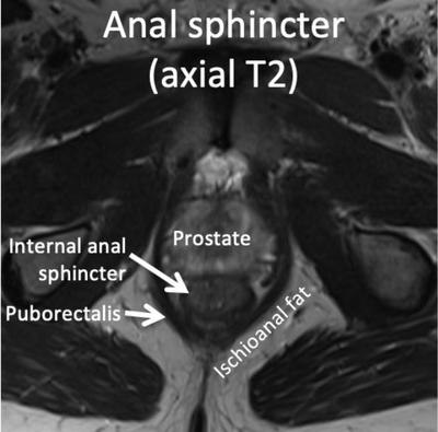Anal sphincter axial T2