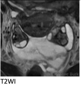 O-RADS MRI, Fallopian tube descriptors, Peritoneal inclusion cyst