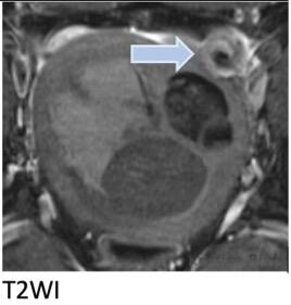 O-RADS MRI, Fallopian tube descriptors, Ovarian torsion, Twisted pedicle