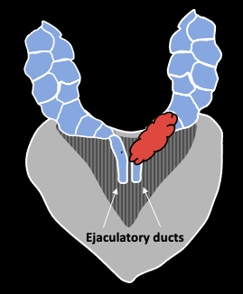 Direct spread along ejaculatory duct into SV