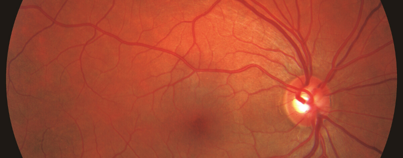 New Image of Glaucoma