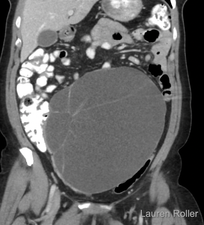 Uncertain Diagnosis or simple-appearing cyst ≥ 10 cm