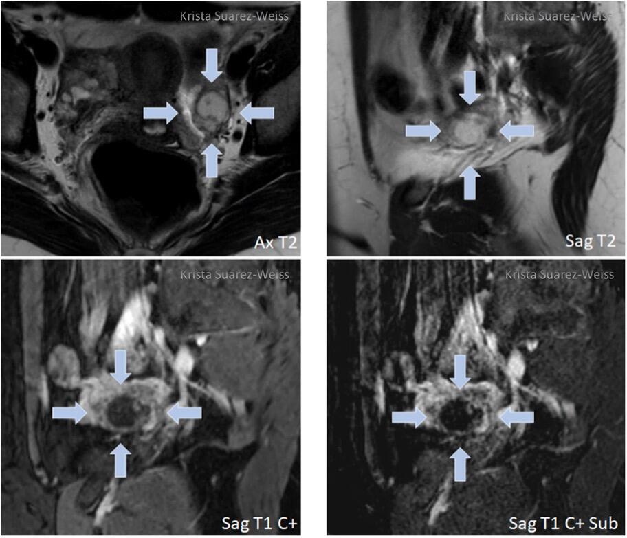 O-RADS MRI Example 3