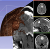 Representación Tridimensional de un Tumor Cerebral e Imágenes de RMN